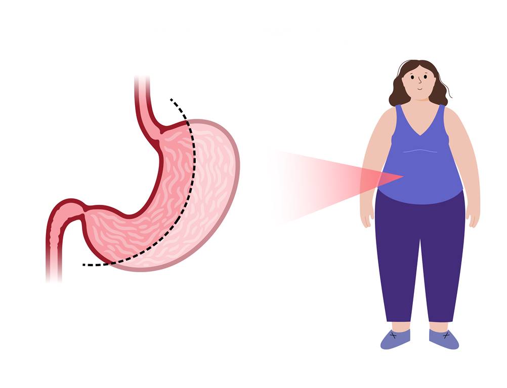 Cirurgia bariátrica, quem pode fazer?
